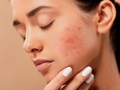 25 proven ways to prevent and get rid of pimples