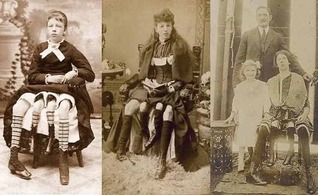 Life and times of Josephine Myrtle Corbin, the 4 legged woman from Texas