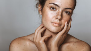 Hyperpigmentation - What are the causes of melasma