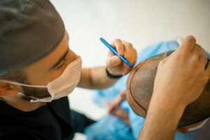 Doctor is doing hair transplant surgery