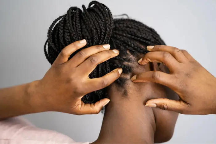 Can Black People Get Lice?