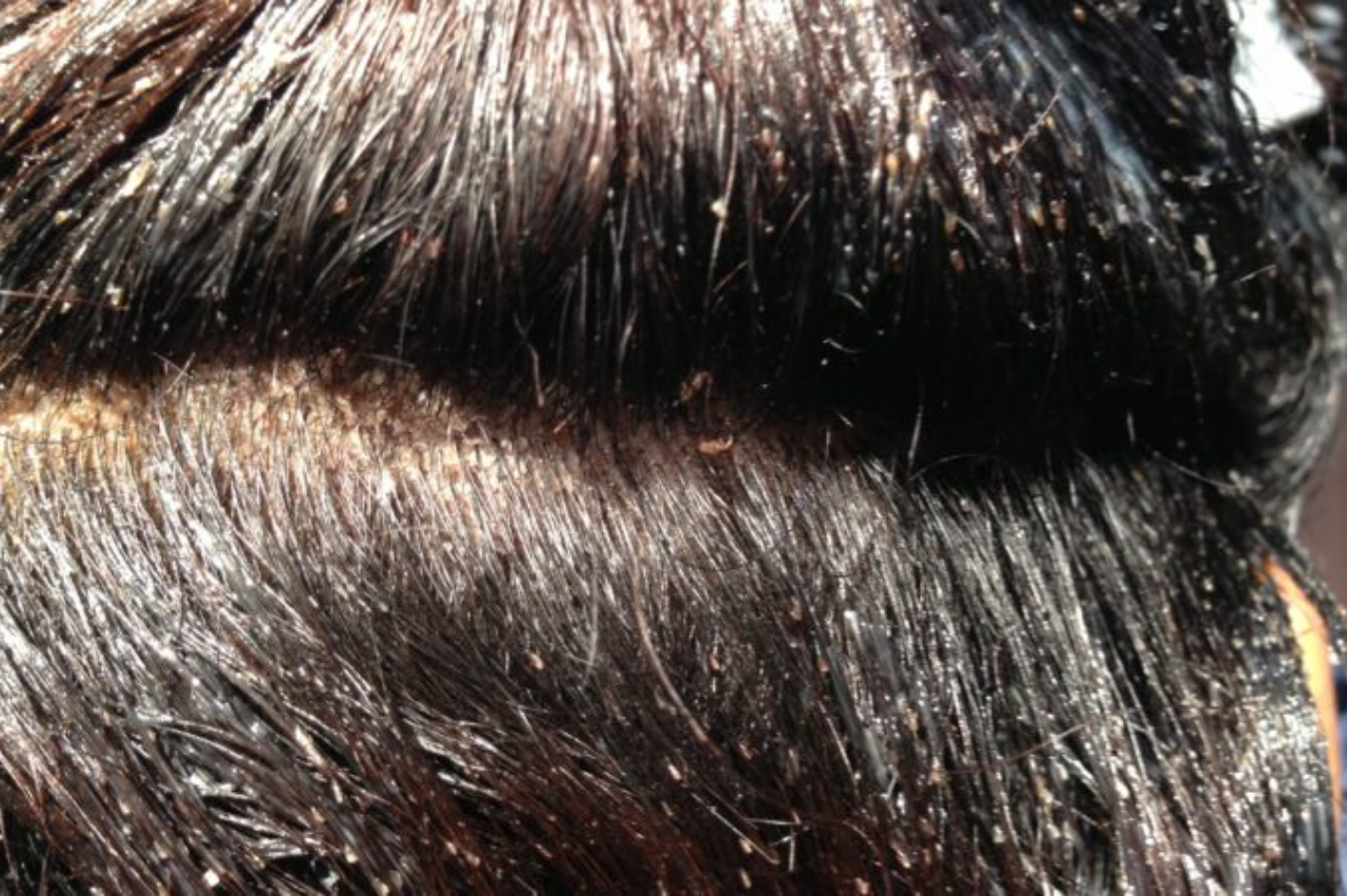 Lice in Hair